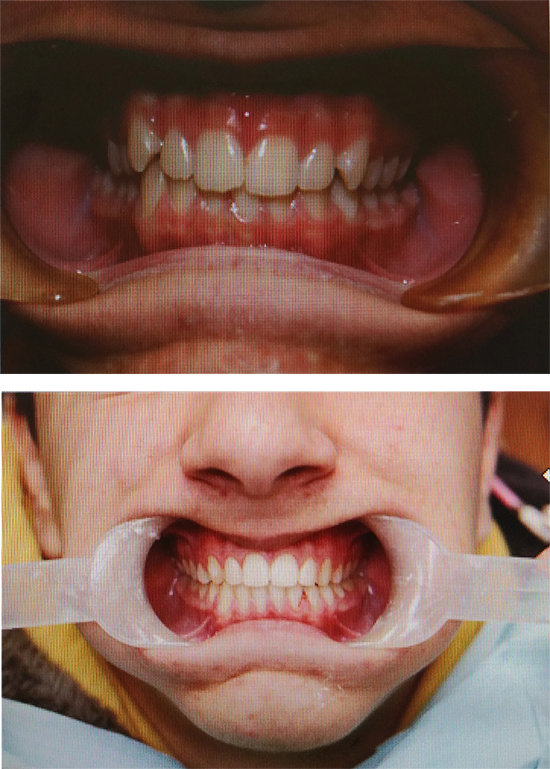 The image shows a person s mouth with an oral appliance, and it appears to be a before-and-after photo of dental treatment, highlighting the difference in appearance and possibly function after dental work.