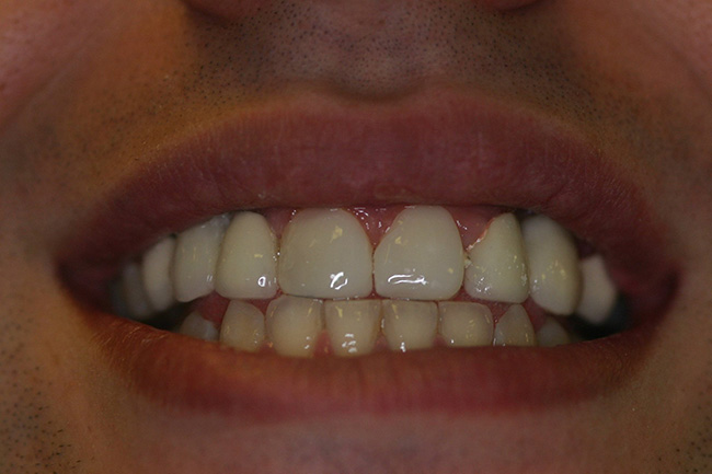 The image shows a close-up of a person s smiling face, with their teeth prominently visible and their mouth wide open.