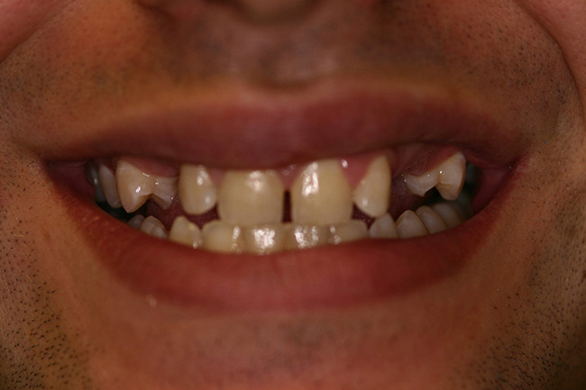 The image displays a close-up of a person s face with a noticeable smile, showing teeth that are significantly crooked and uneven.
