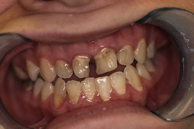 Dental patient with a mouth full of teeth, showing a close-up view of their oral health.