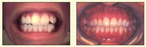 The image shows a collage of three photographs featuring an individual s teeth. In the top left photo, the person is smiling with their teeth visible, revealing some staining or discoloration. The top right photo focuses on the lower part of the mouth, showing the teeth in detail with the lips slightly apart. The bottom photo provides a close-up view of the upper set of teeth and gums, highlighting the teeth s condition with a focus on the front teeth.