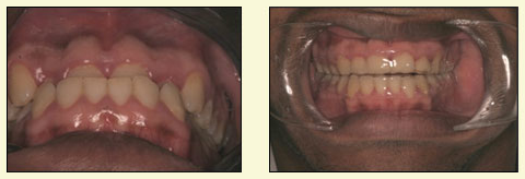 The image shows two photographs of a person's mouth with teeth, one showing the upper teeth and the other showing the lower teeth.