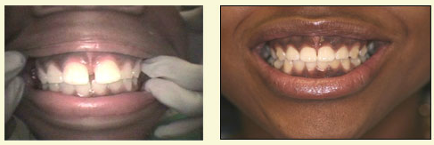 Two images side by side: one of a person with a wide smile showing teeth, and the other of a close-up of a smiling mouth with visible braces.