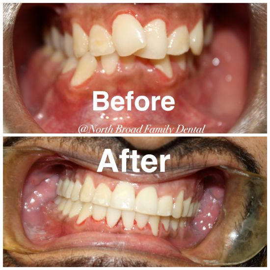The image shows a before-and-after comparison of dental work, with the top half showing a smiling mouth with yellowed teeth and the bottom half displaying the same teeth after being treated, now appearing brighter and cleaner.