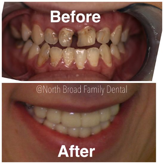 The image shows a before and after comparison of teeth whitening, with the left side showing darkened teeth and the right side displaying brightly white teeth.