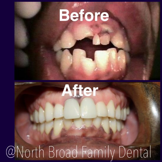 The image shows a before and after comparison of dental work, with the  before  side displaying an open mouth with damaged teeth, and the  after  side showing a closed mouth with restored teeth.