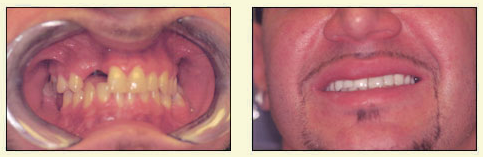 The image shows a person with an open mouth, displaying yellowed teeth and what appears to be gum disease or dental issues.