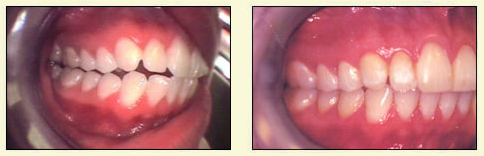 Before and after dental treatment comparison.