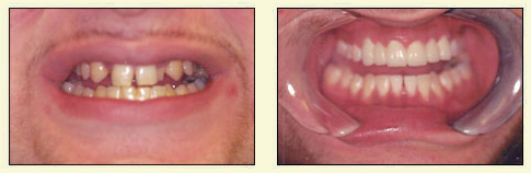 The image shows a side-by-side comparison of a person s teeth before and after dental treatment.