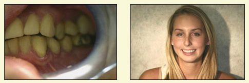 A woman with a wide smile and teeth, captured in a close-up, with an overlaid image of a hand holding a toothbrush and a mouth showing yellowed teeth.