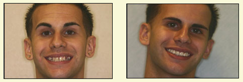 Two images of a man with facial hair, one showing his smile and the other his neutral expression.