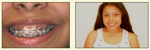 The image shows a before and after comparison of a person s teeth, with the  before  side featuring crooked or misaligned teeth and the  after  side showing straightened teeth.