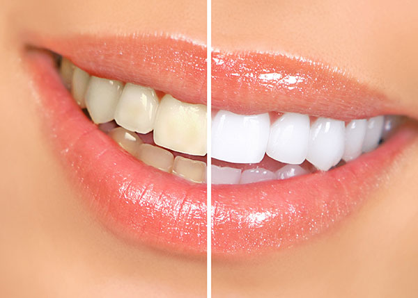 Before and after comparison of a smile with teeth whitening treatment, showcasing the transformation from yellow to white.