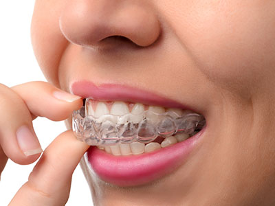 An adult woman with a clear, straight smile is holding her bottom teeth in her hand while wearing an upper retainer.