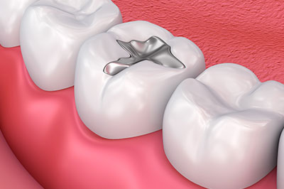 The image shows a dental implant, which is a small screw-like device inserted into the jawbone to replace a missing tooth.