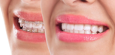 Close-up of a smiling woman displaying her teeth and lips, set against a blurred background.