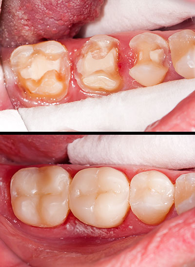 The image shows a close-up of a person s mouth with teeth that appear to be in poor condition, possibly due to decay or gum disease.