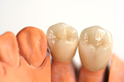 An image showing a set of artificial teeth with visible enamel and dentin details, placed on a white background.