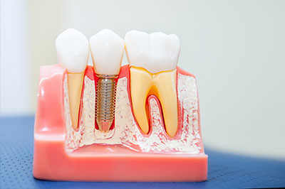 The image shows a dental model with teeth and gums, featuring various dental tools such as drills and brushes, and an implant, all set against a blue background.