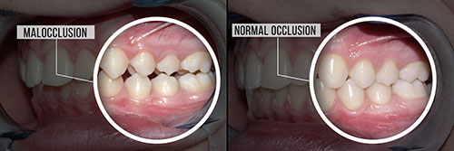 The image shows a side-by-side comparison of two different dental procedures, with the left side showing a normal occlusion and the right side illustrating malocclusion.