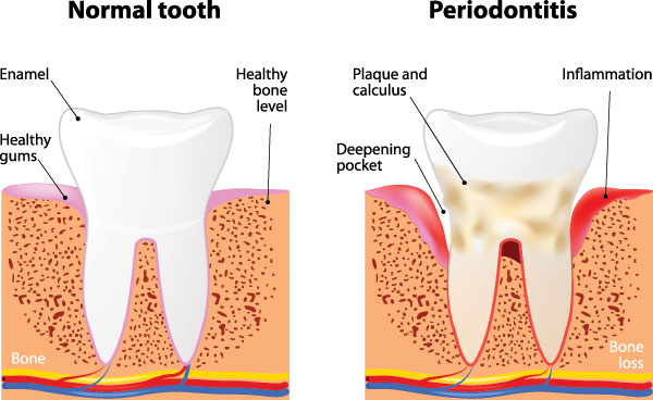 The image presents a detailed illustration of the stages of tooth decay, from normal to periodontitis, with annotations explaining each stage.