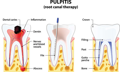 The image is a medical illustration showing a simplified cross-sectional view of a tooth with pulpitis, highlighting the inflammation and infection within the pulp chamber.