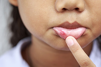 A young child with a noticeable red spot on their face, holding up a finger to touch the spot.