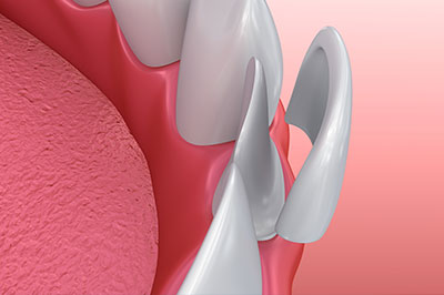 An image of a dental implant with a screw and abutment, placed over a pink background.