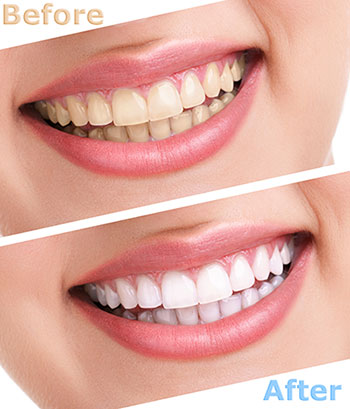 The image shows a before-and-after comparison of teeth whitening, with the top half of the image showing a person s smile with noticeable yellowing and staining, while the bottom half displays the same individual s smile after undergoing a teeth whitening procedure, appearing brighter and cleaner.