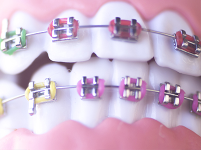 The image shows a close-up of a person s teeth with multiple colored braces, featuring shades of pink, yellow, and green.